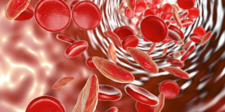 Sickle cell anemia, 3D illustration showing blood vessel with normal and deformated crescent-like red blood cells